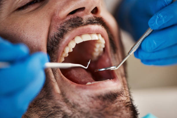 Best Emergency Dental Care for Broken or Chipped Teeth in South Gate Ridge, FL